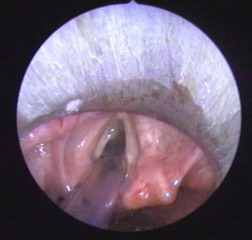 Hạt xơ dây thanh, polyp dây thanh, u nang dây thanh